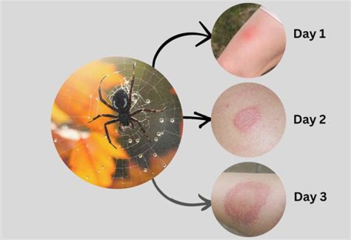 Can a spider bite give you a staph infection?