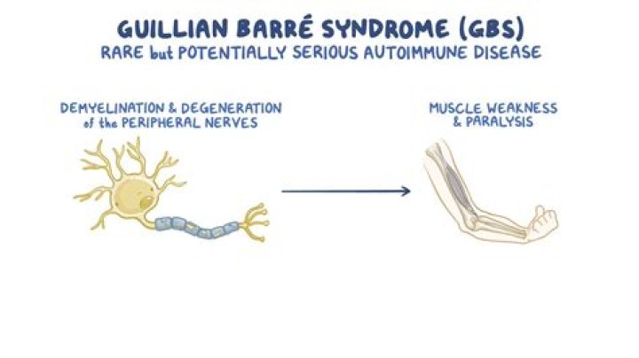 Can Guillain-Barre syndrome affect the brain?