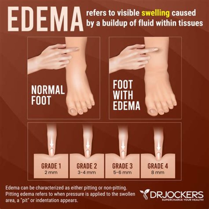 Can pedal edema be cured?