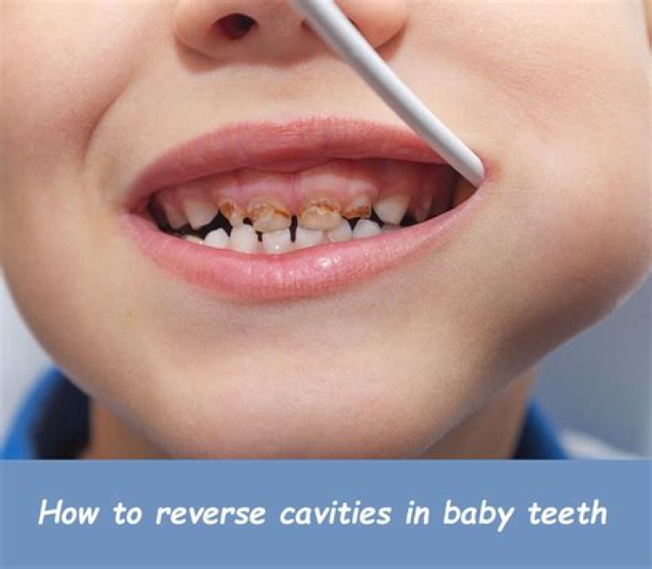 Can you reverse tooth erosion?