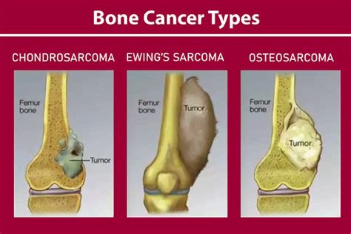 Can you survive metastatic osteosarcoma?