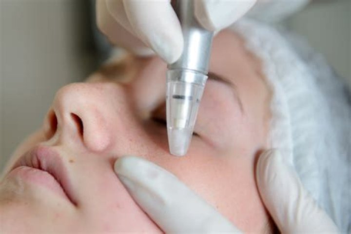 Does microdermabrasion work for men?