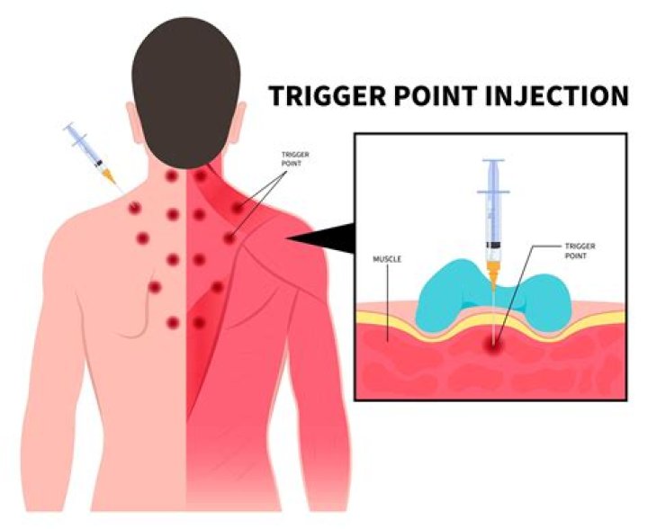 Does trigger point therapy help fibromyalgia?