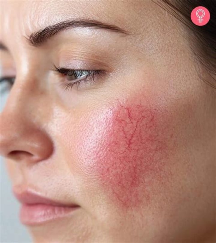 How do I get rid of broken capillaries on my face?