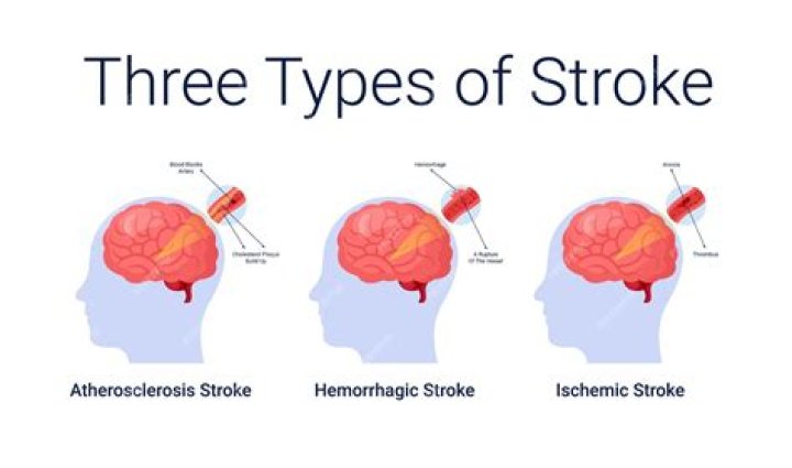 How does alteplase work for stroke?