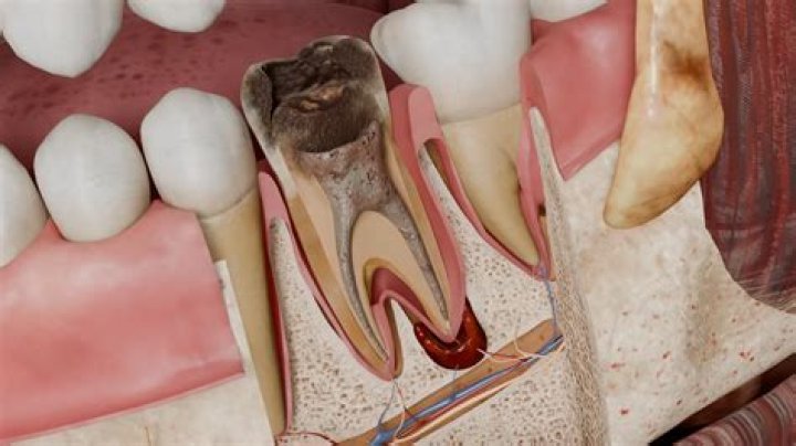 How is periapical pathology treated?