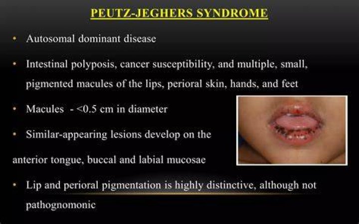How is Peutz-Jeghers Syndrome diagnosed?