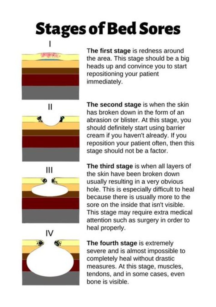How is Stage 4 bed sores treated?