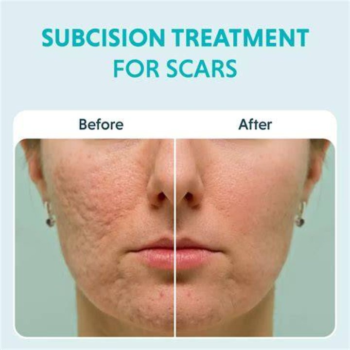 How long does it take for scars to fade after breast surgery?