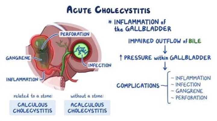 Is cholecystitis associated with pancreatitis?