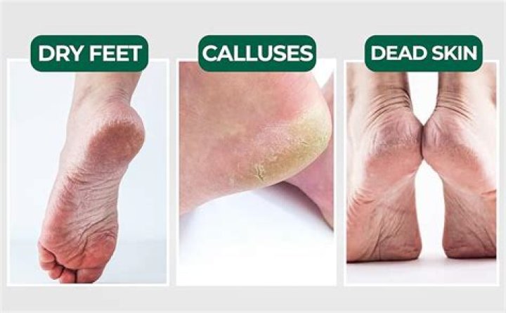 Is it bad to peel calluses off feet?