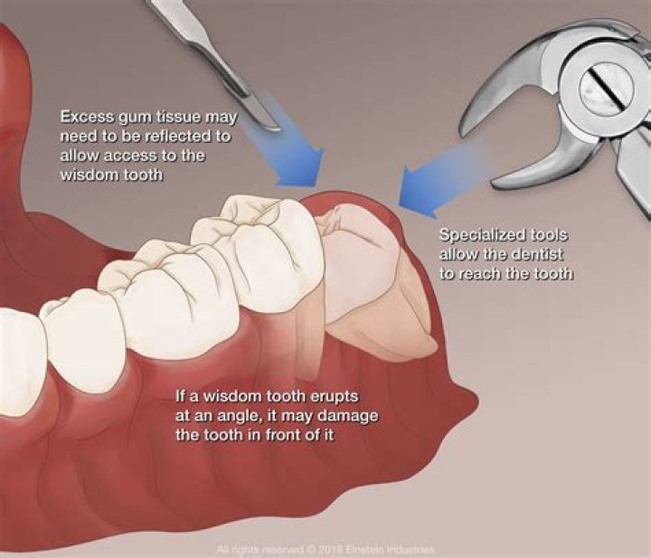 Is it easier to remove erupted wisdom teeth?