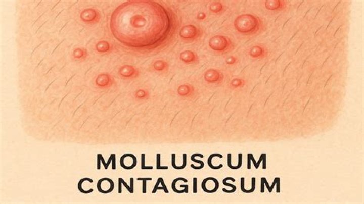 Is molluscum contagiosum a form of HPV?