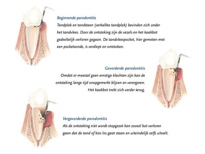 Wat te doen als stukje tand afgebroken?