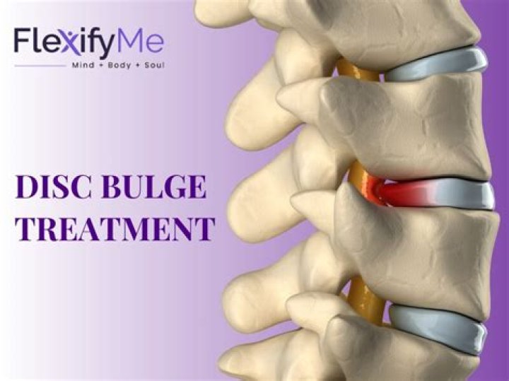 What does circumferential disc bulge mean?
