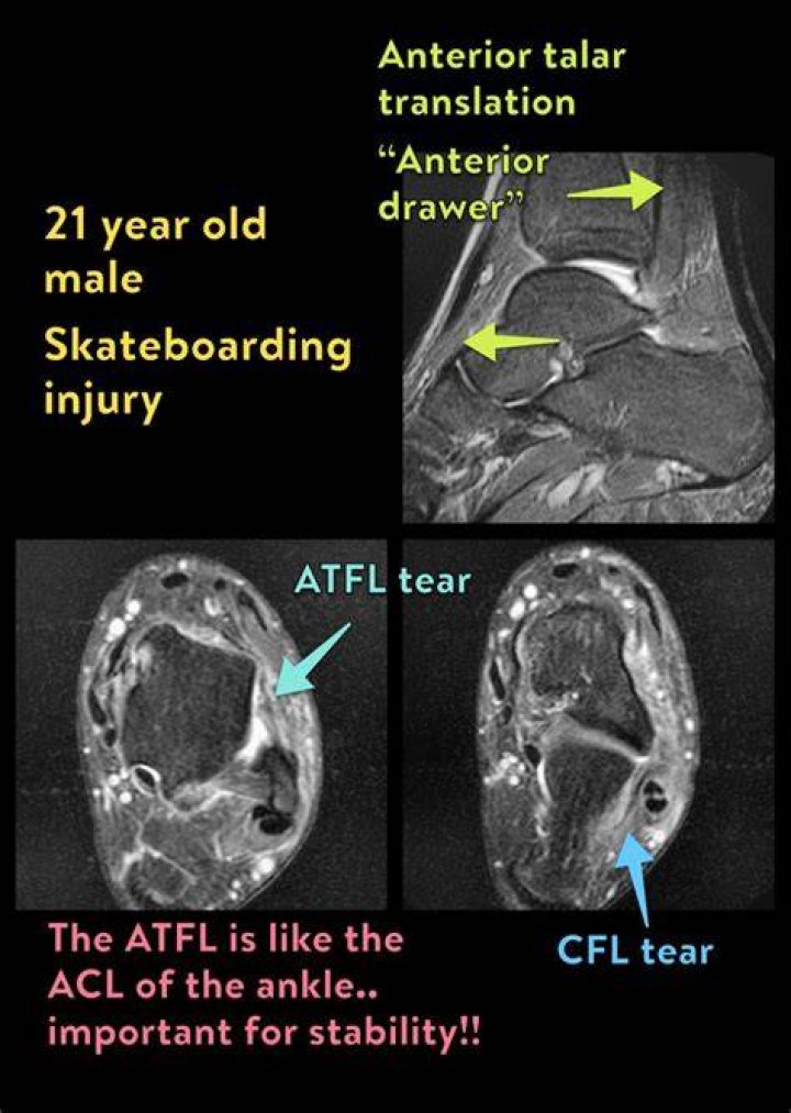 What is a CFL in ankle?