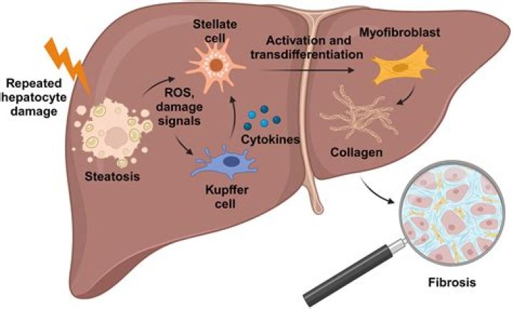 What is liver fibrosis and inflammation?