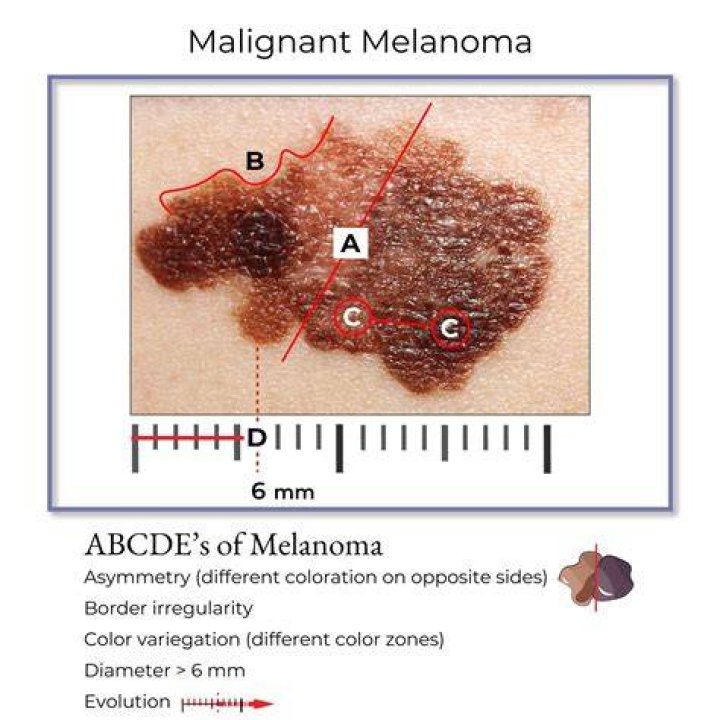 What is malignant melanoma defined as?