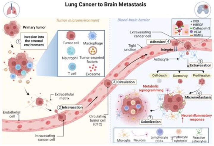 What is metastasis to the lungs?