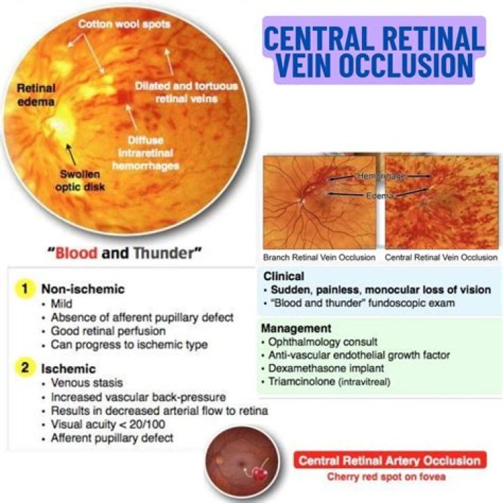 What is the blood and thunder retina?
