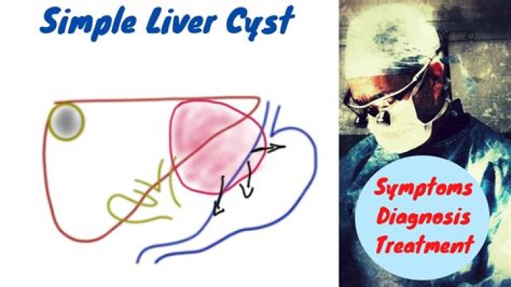 What is the most common symptom of a simple liver cyst?