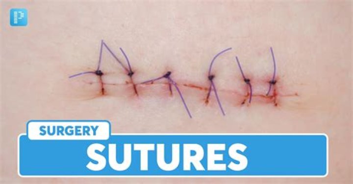 What suture is used for eyes?