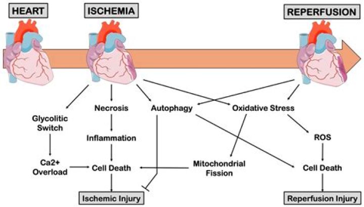 Which cardiac disorder is irreversible?